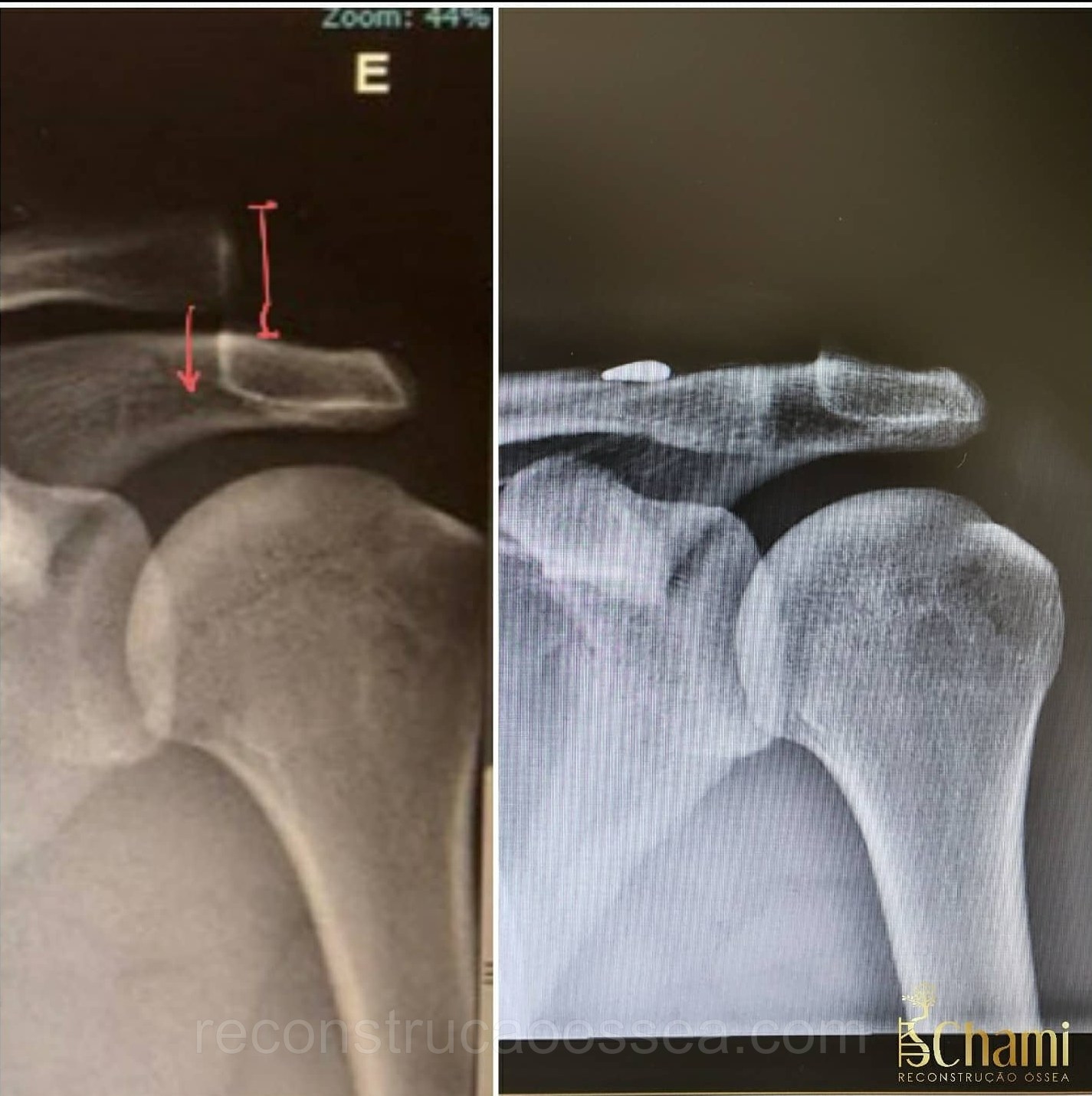 luxacao-acromio-clavicular-tratamento-cirurgico-2