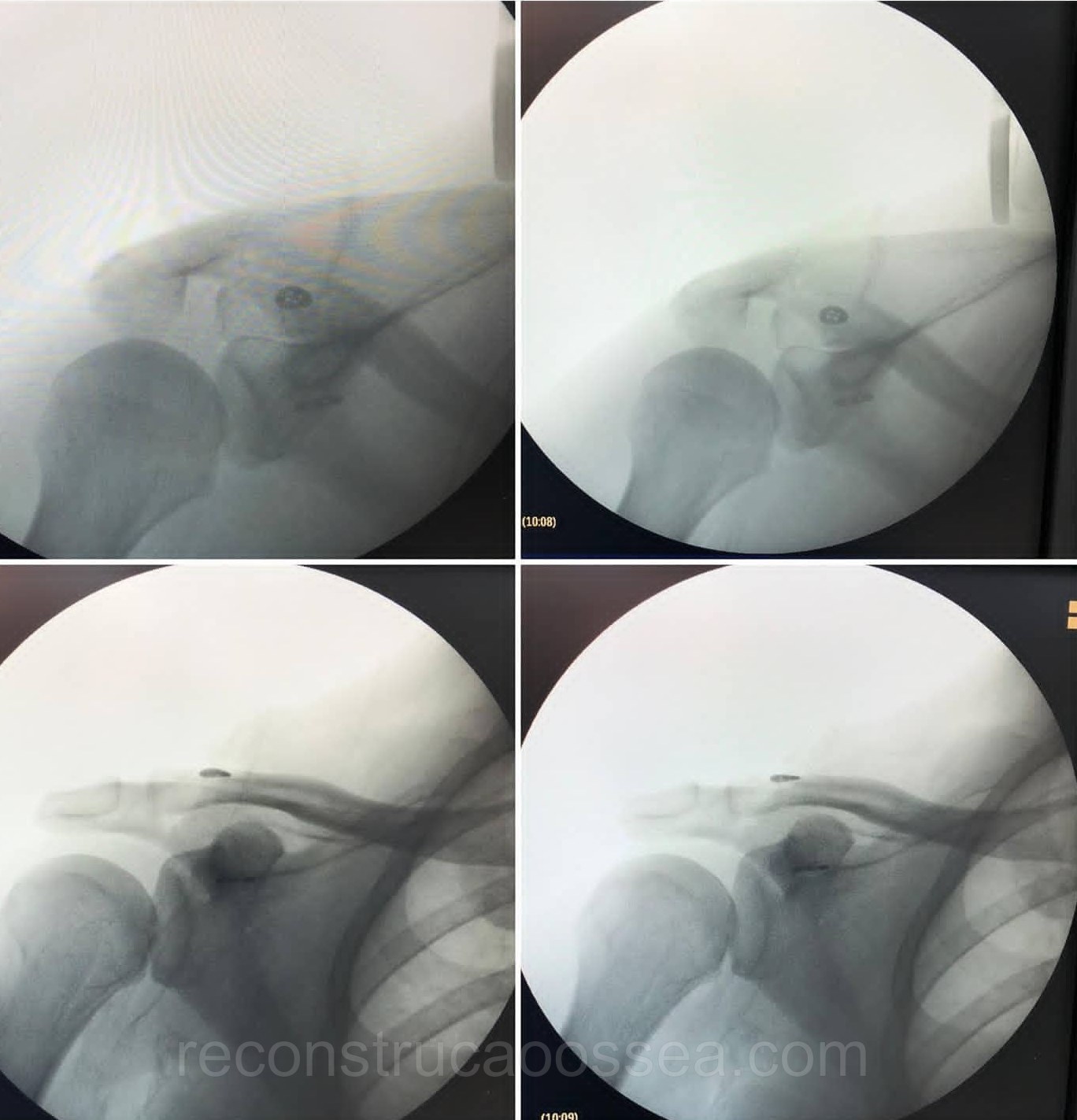 luxacao-acromio-clavicular-tratamento-cirurgico-4