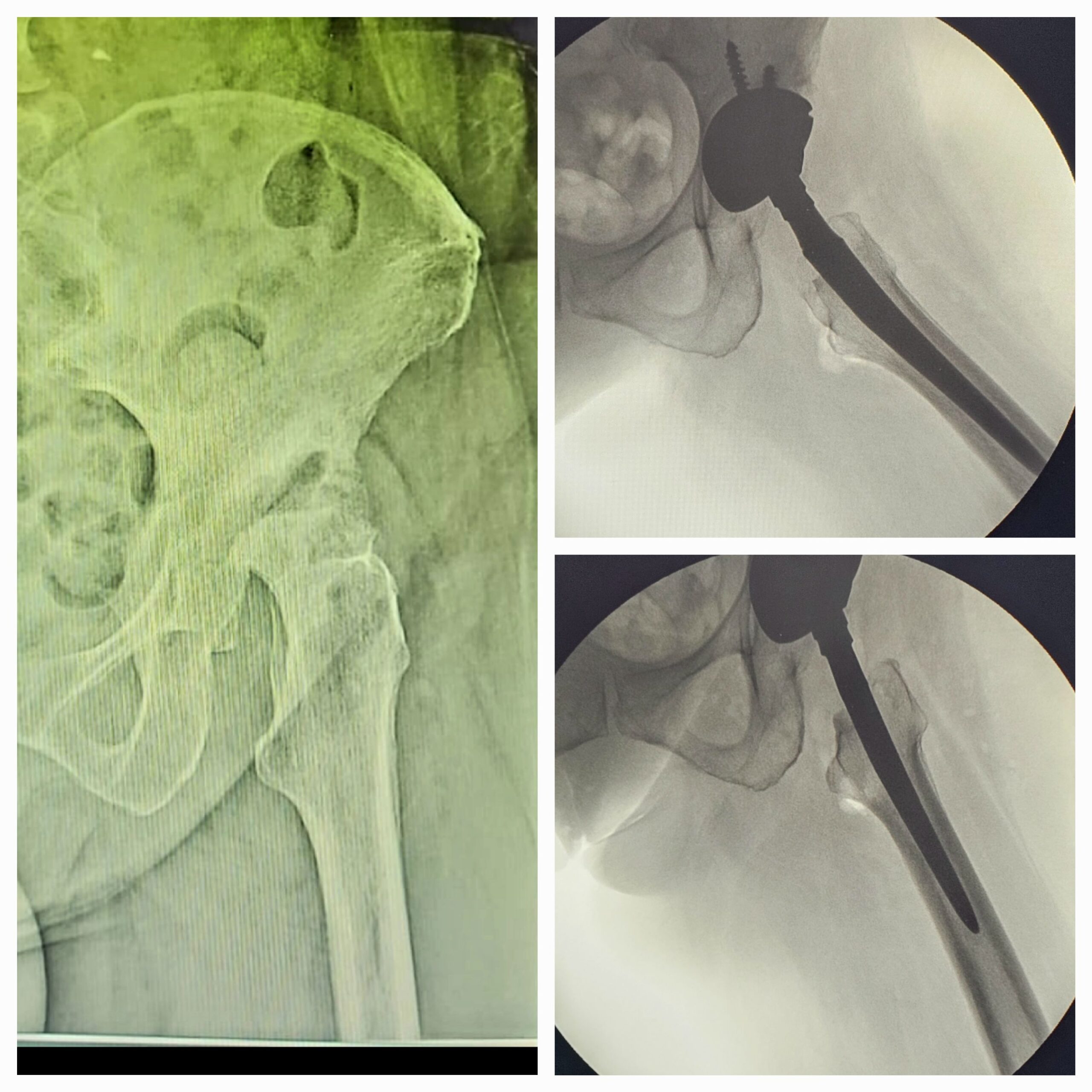 Artroplastia total do quadril por coxartrose ou fratura do colo do femur