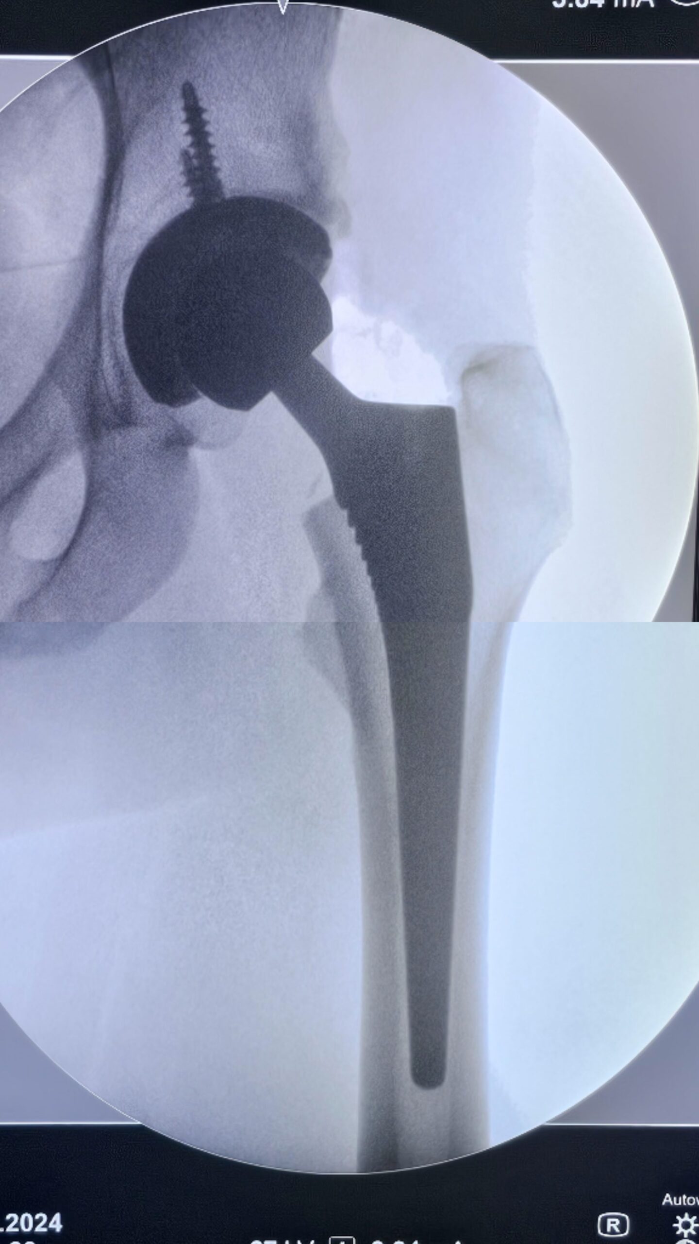 Artroplastia total do quadril por coxartrose ou fratura do colo do femur