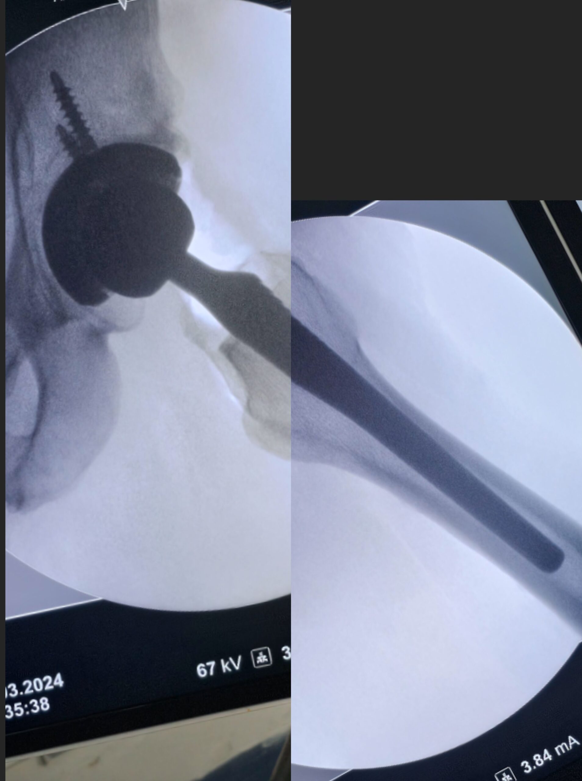 Artroplastia total do quadril por coxartrose ou fratura do colo do femur