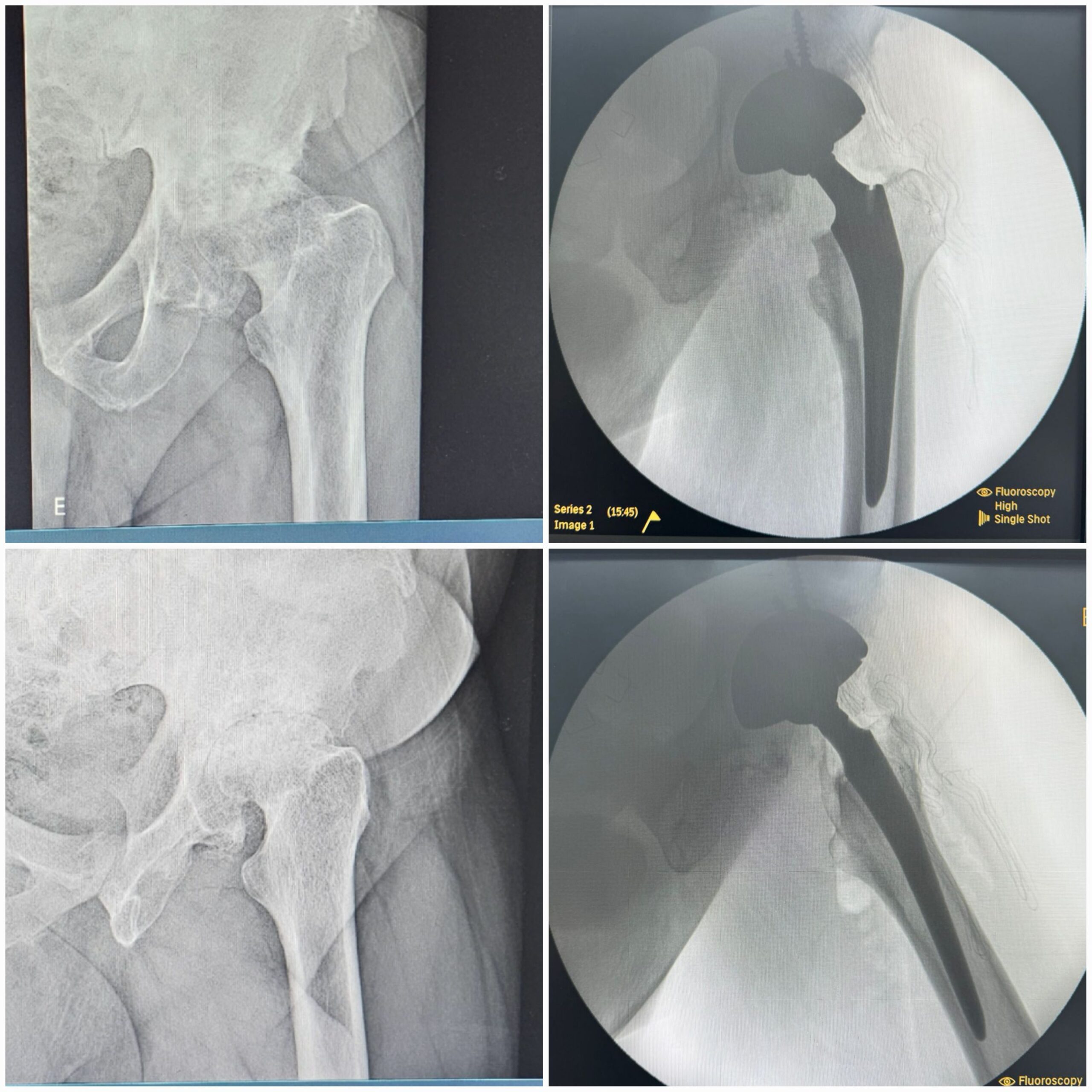 Artroplastia total do quadril por coxartrose ou fratura do colo do femur