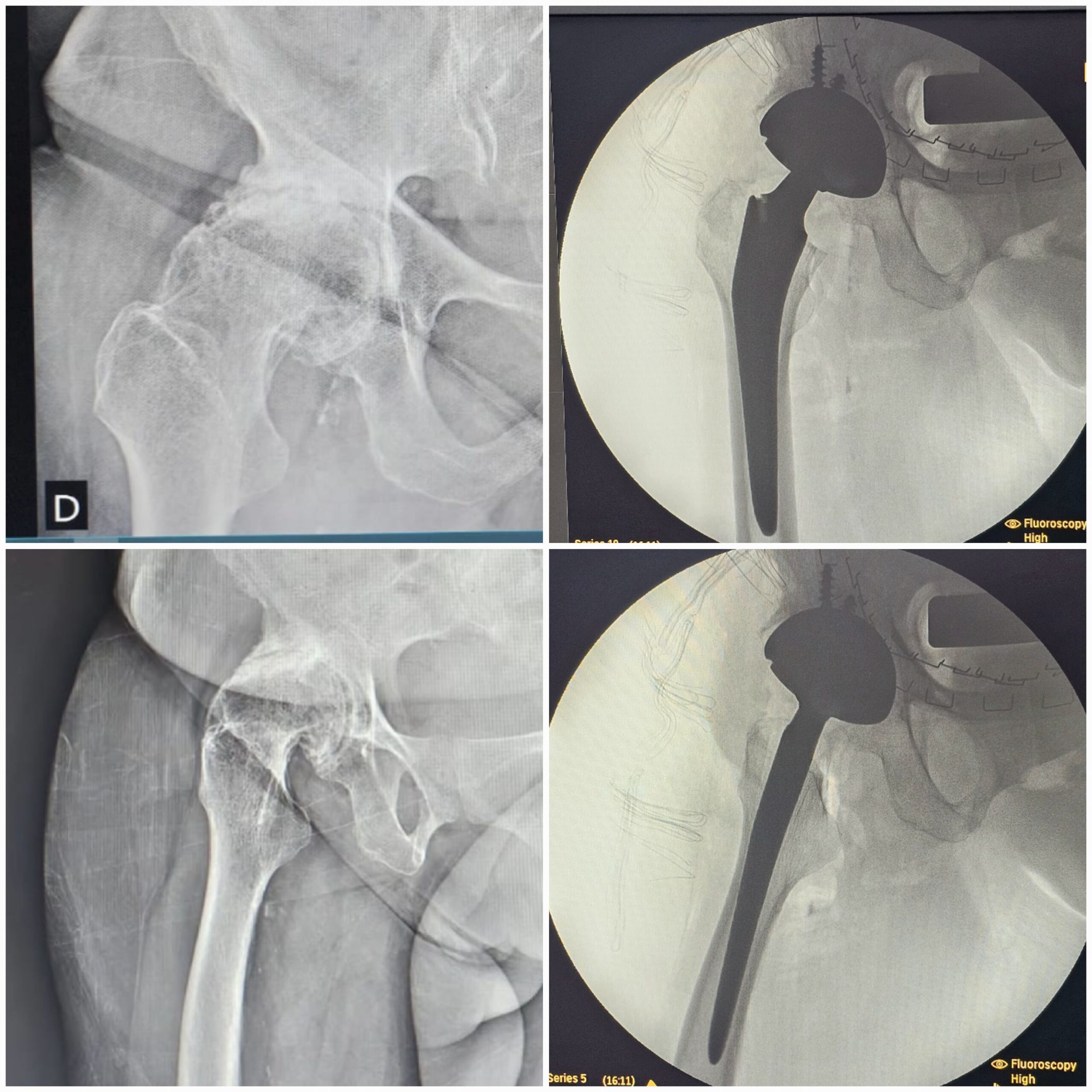 Artroplastia total do quadril por coxartrose ou fratura do colo do femur