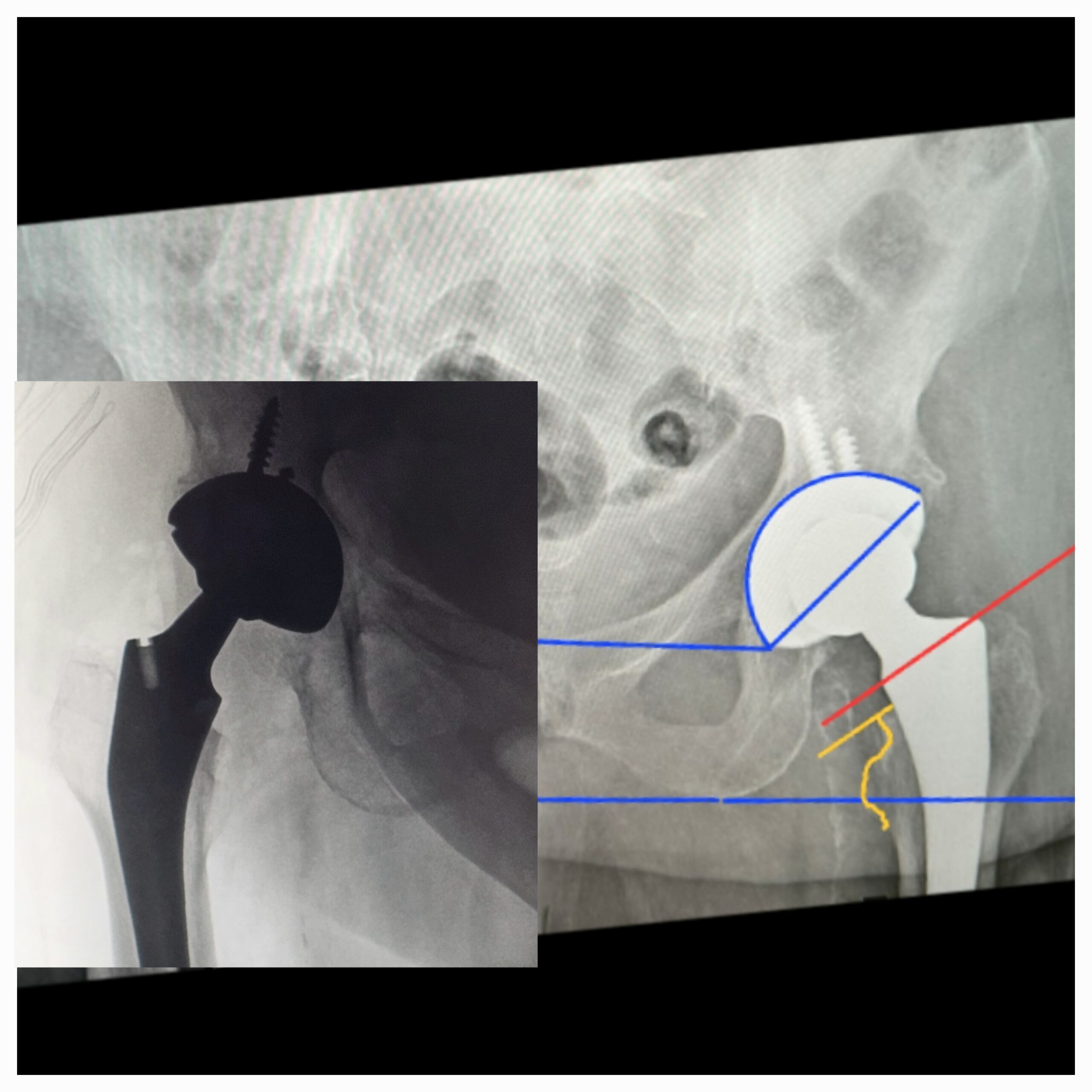 Artroplastia total do quadril por coxartrose ou fratura do colo do femur