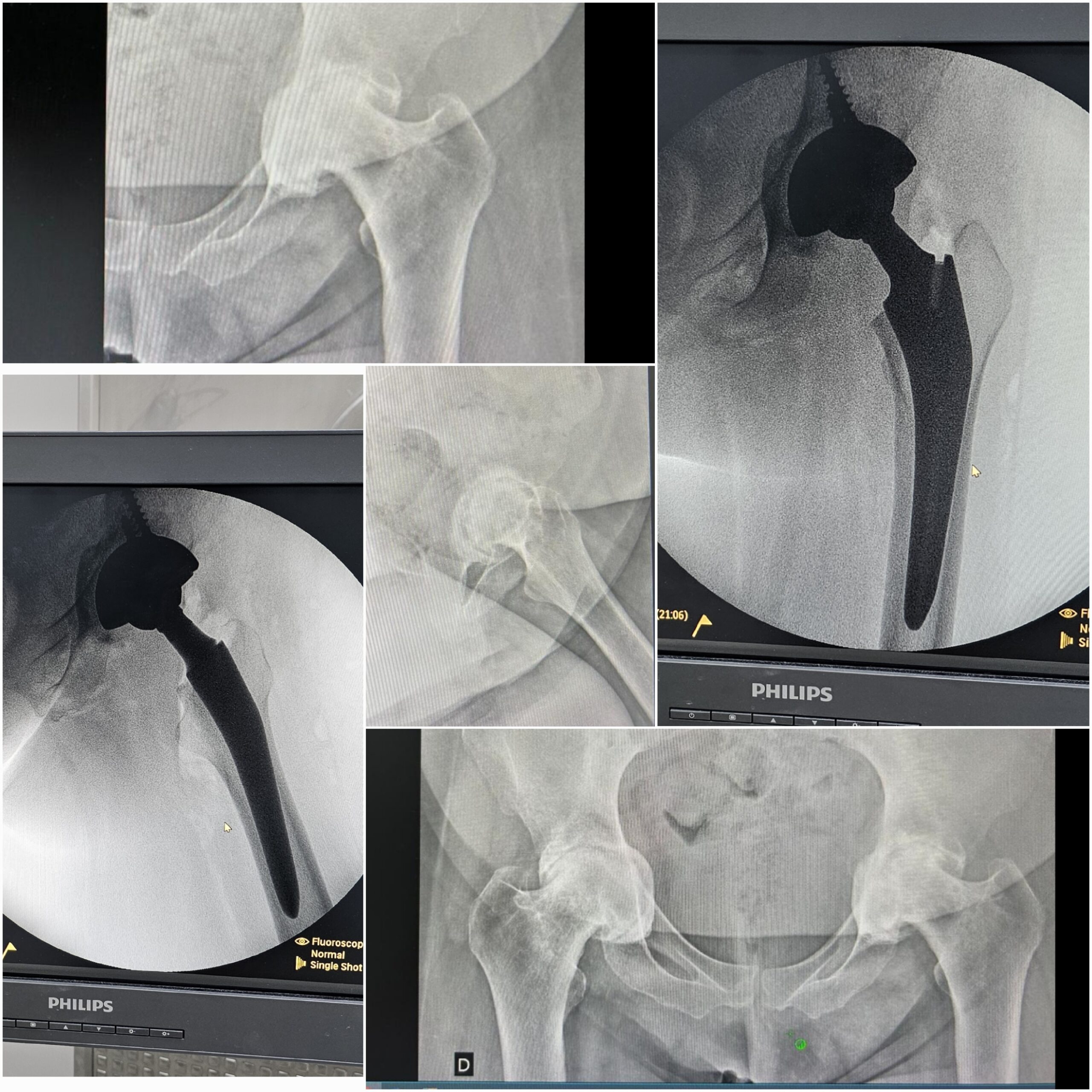 Artroplastia total do quadril por coxartrose ou fratura do colo do femur