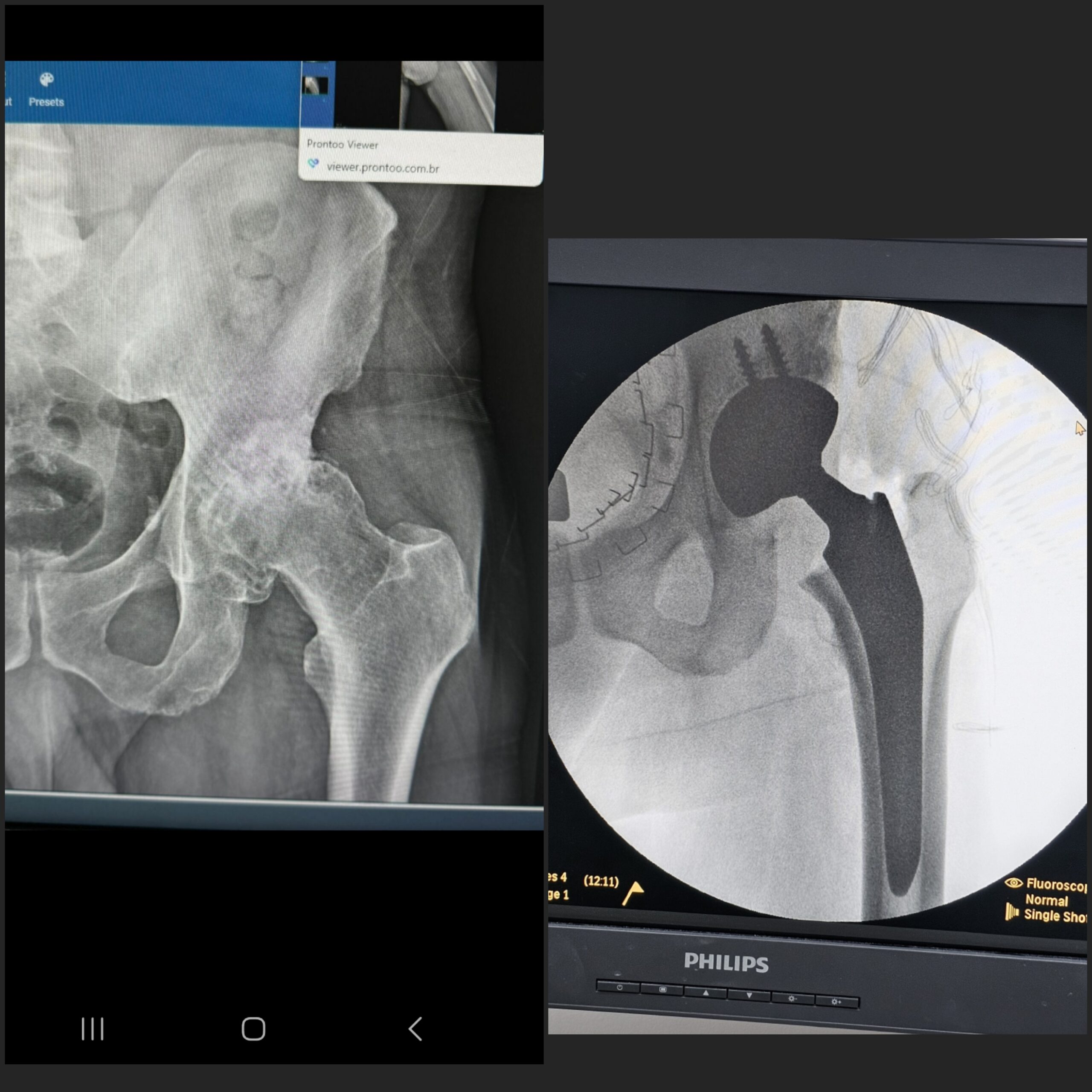 Artroplastia total do quadril por coxartrose ou fratura do colo do femur