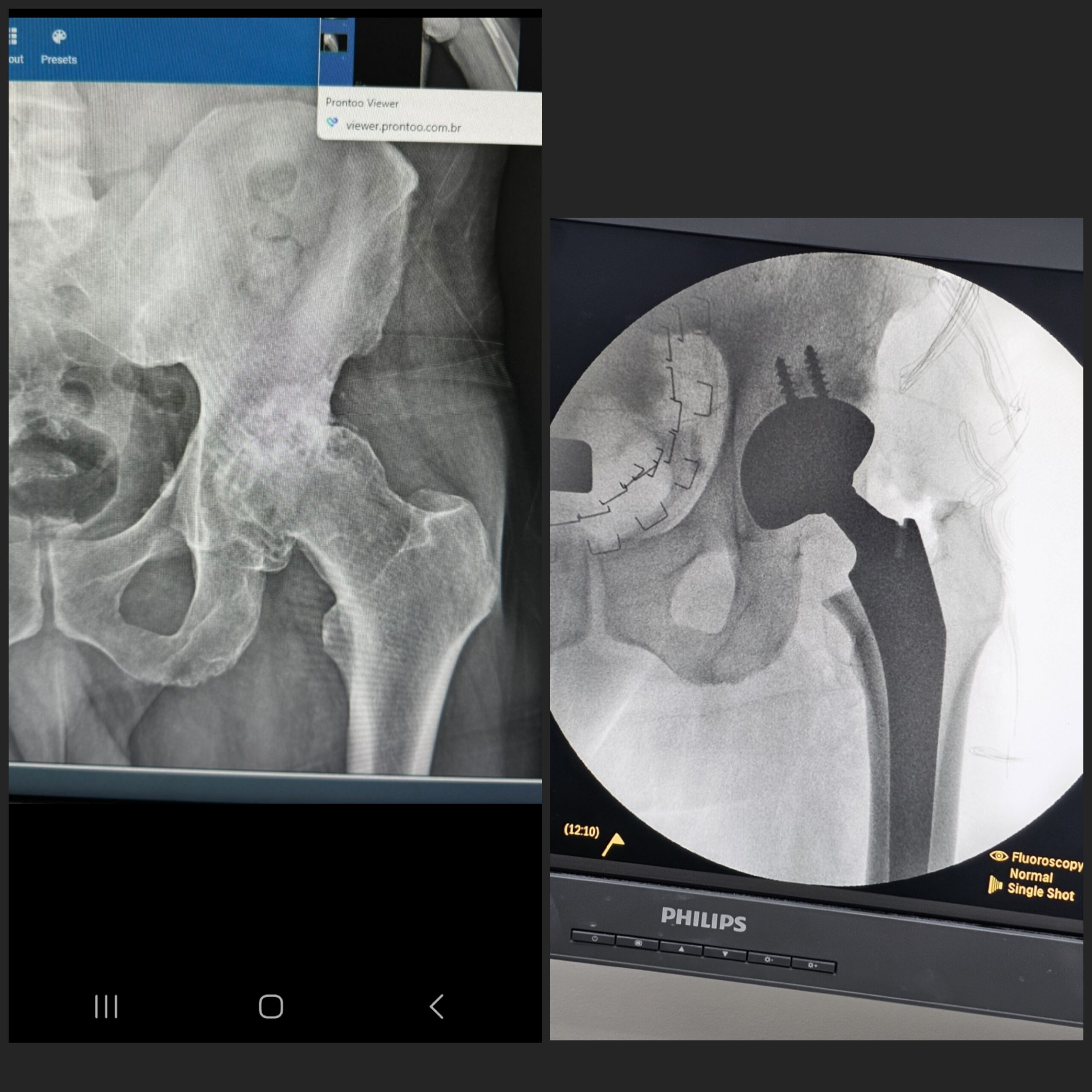 Artroplastia total do quadril por coxartrose ou fratura do colo do femur