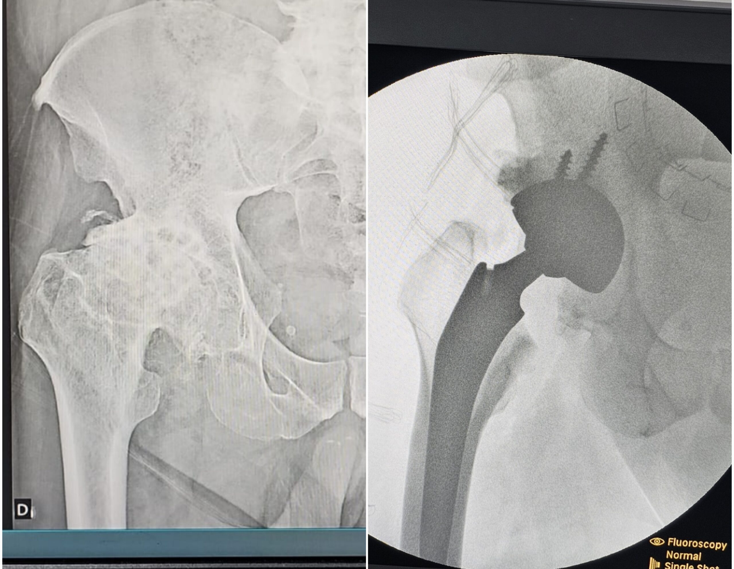 Artroplastia total do quadril por coxartrose ou fratura do colo do femur