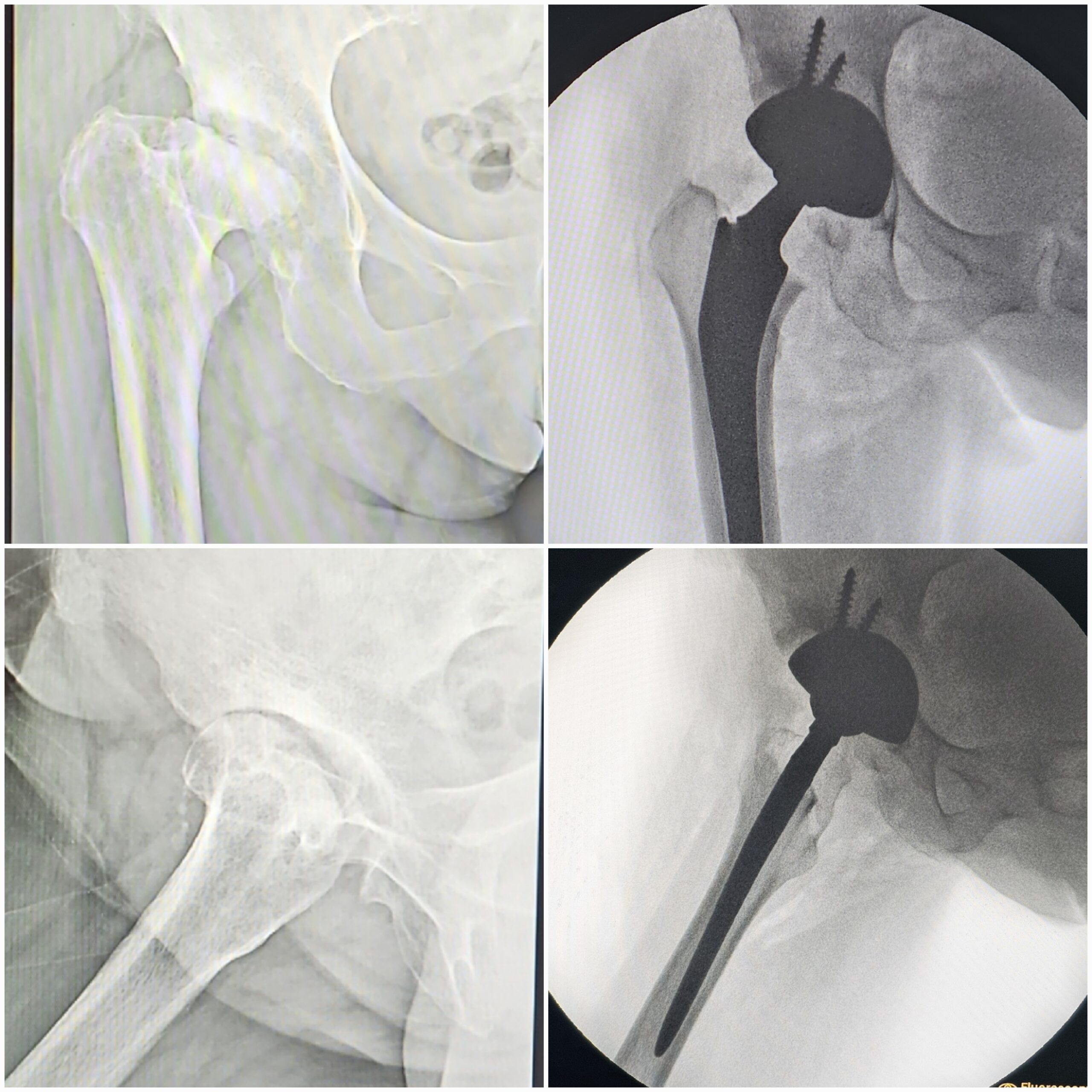 Artroplastia total do quadril por coxartrose ou fratura do colo do femur