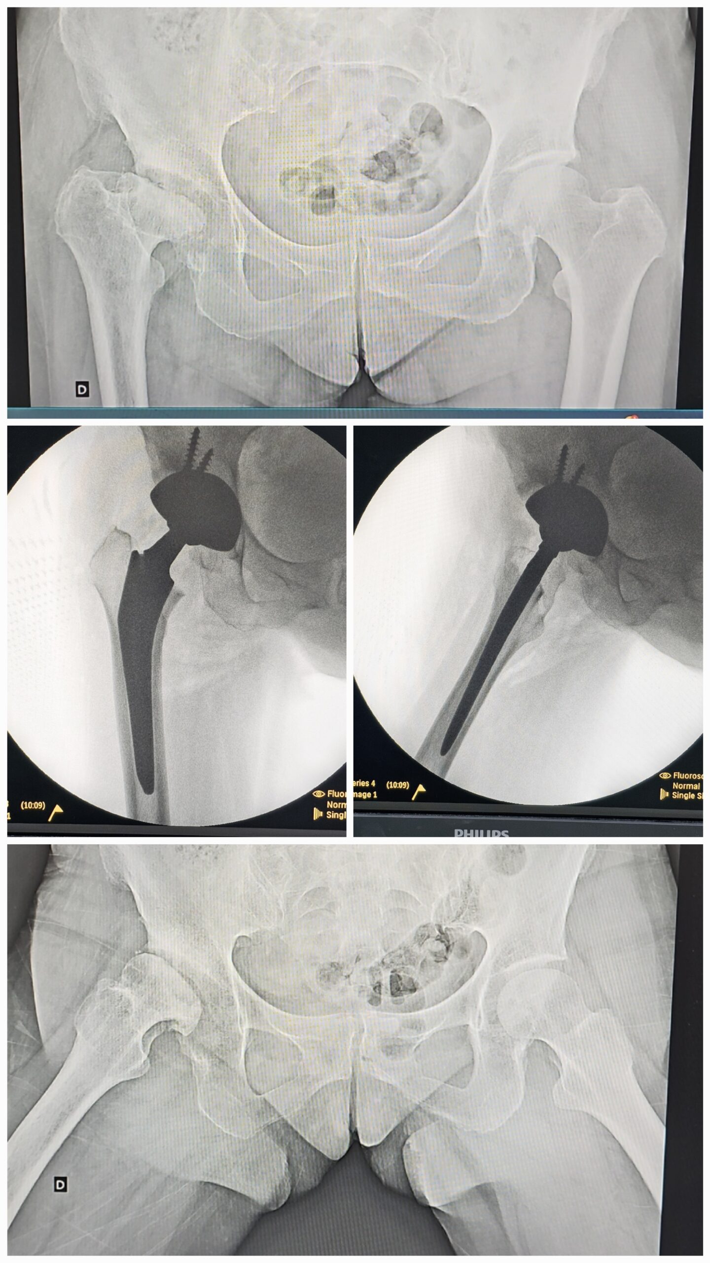 Artroplastia total do quadril por coxartrose ou fratura do colo do femur