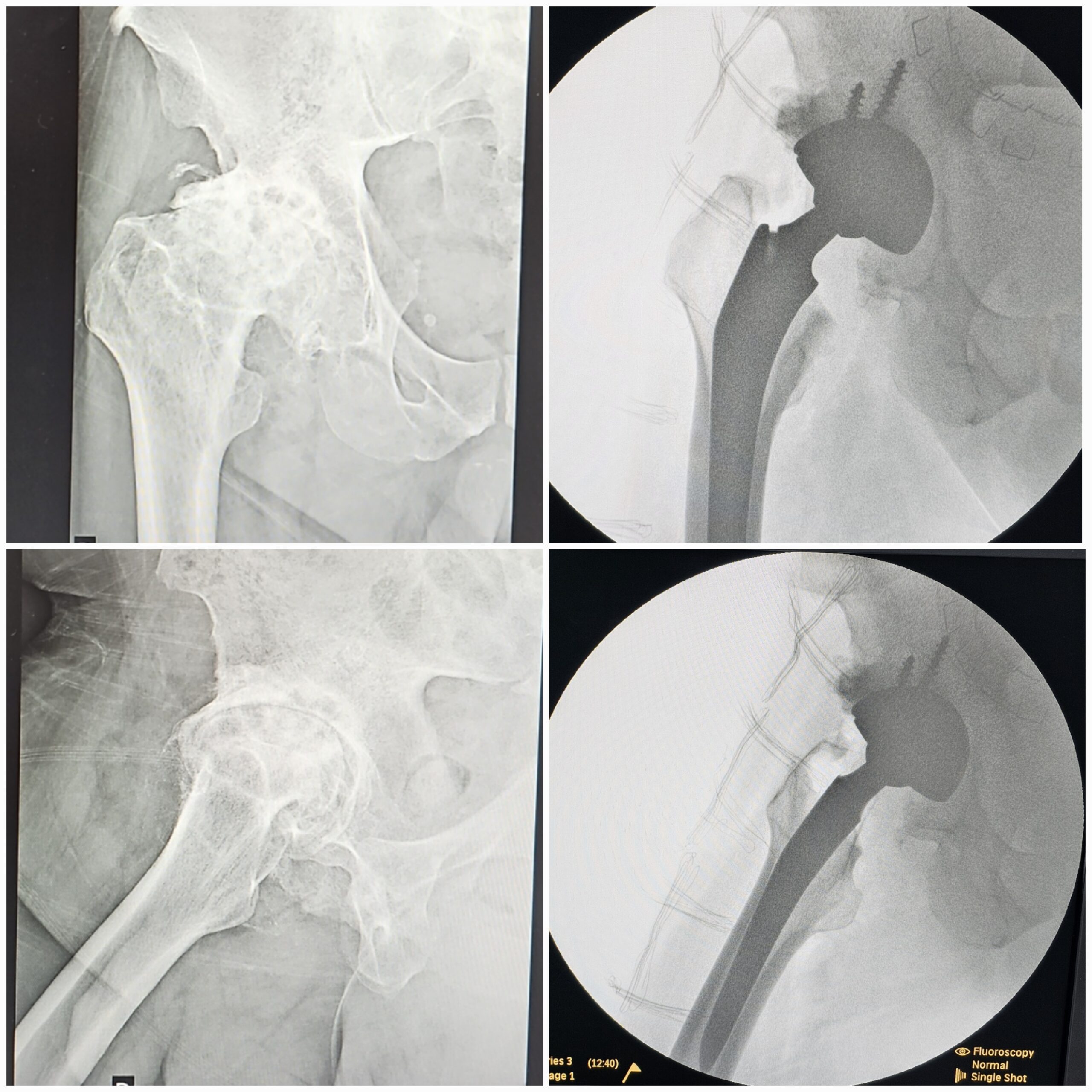 Artroplastia total do quadril por coxartrose ou fratura do colo do femur