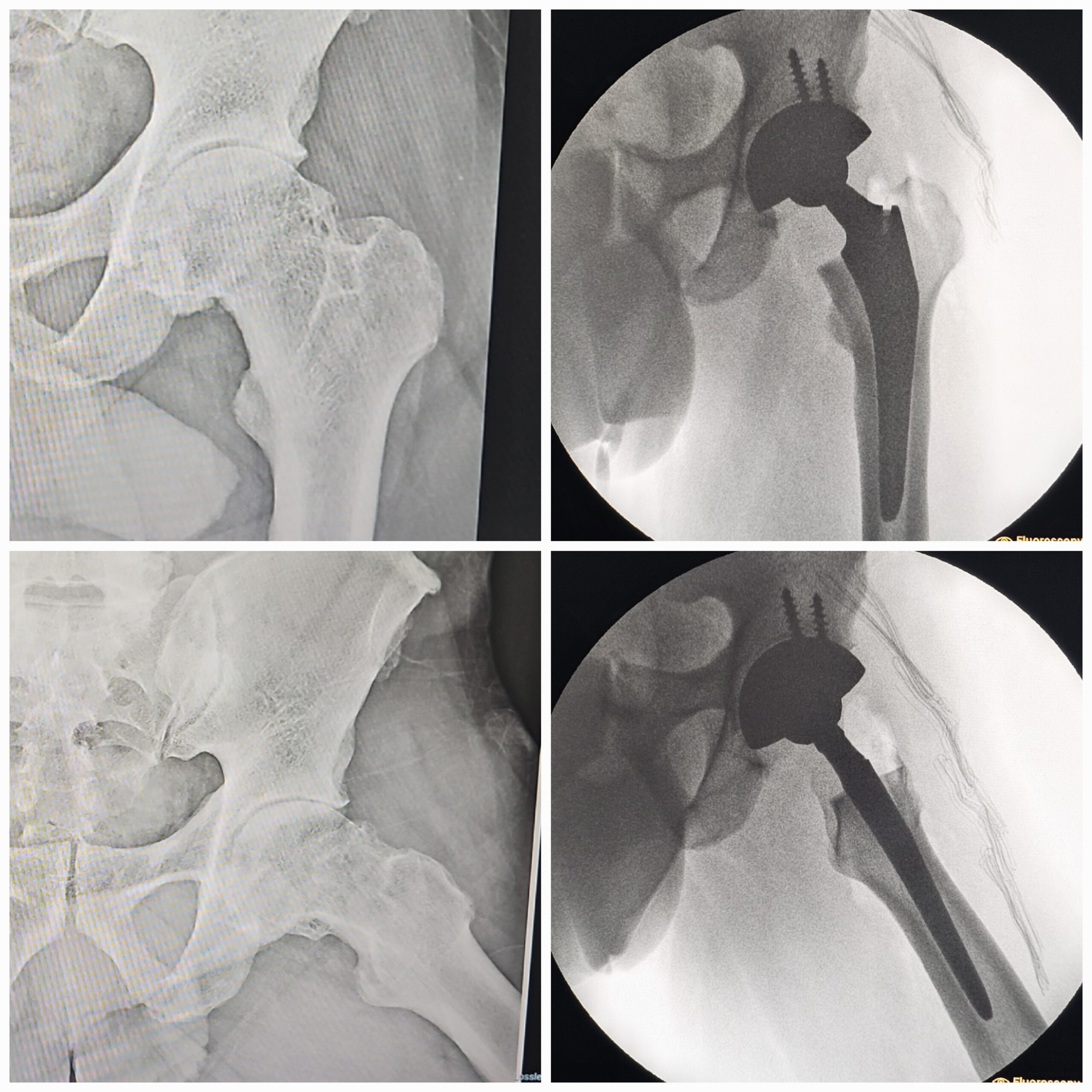 Artroplastia total do quadril por coxartrose ou fratura do colo do femur