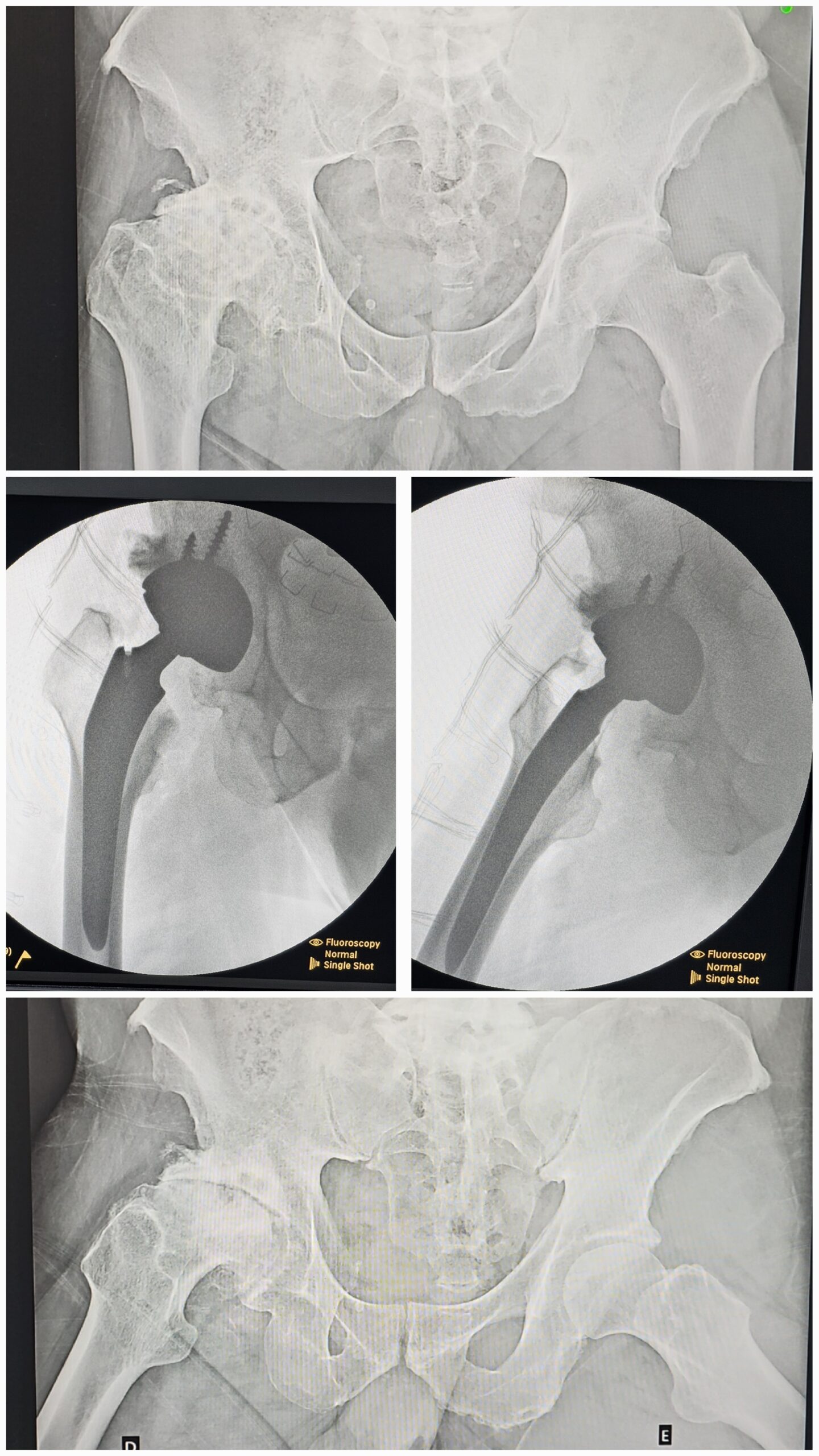 Artroplastia total do quadril por coxartrose ou fratura do colo do femur