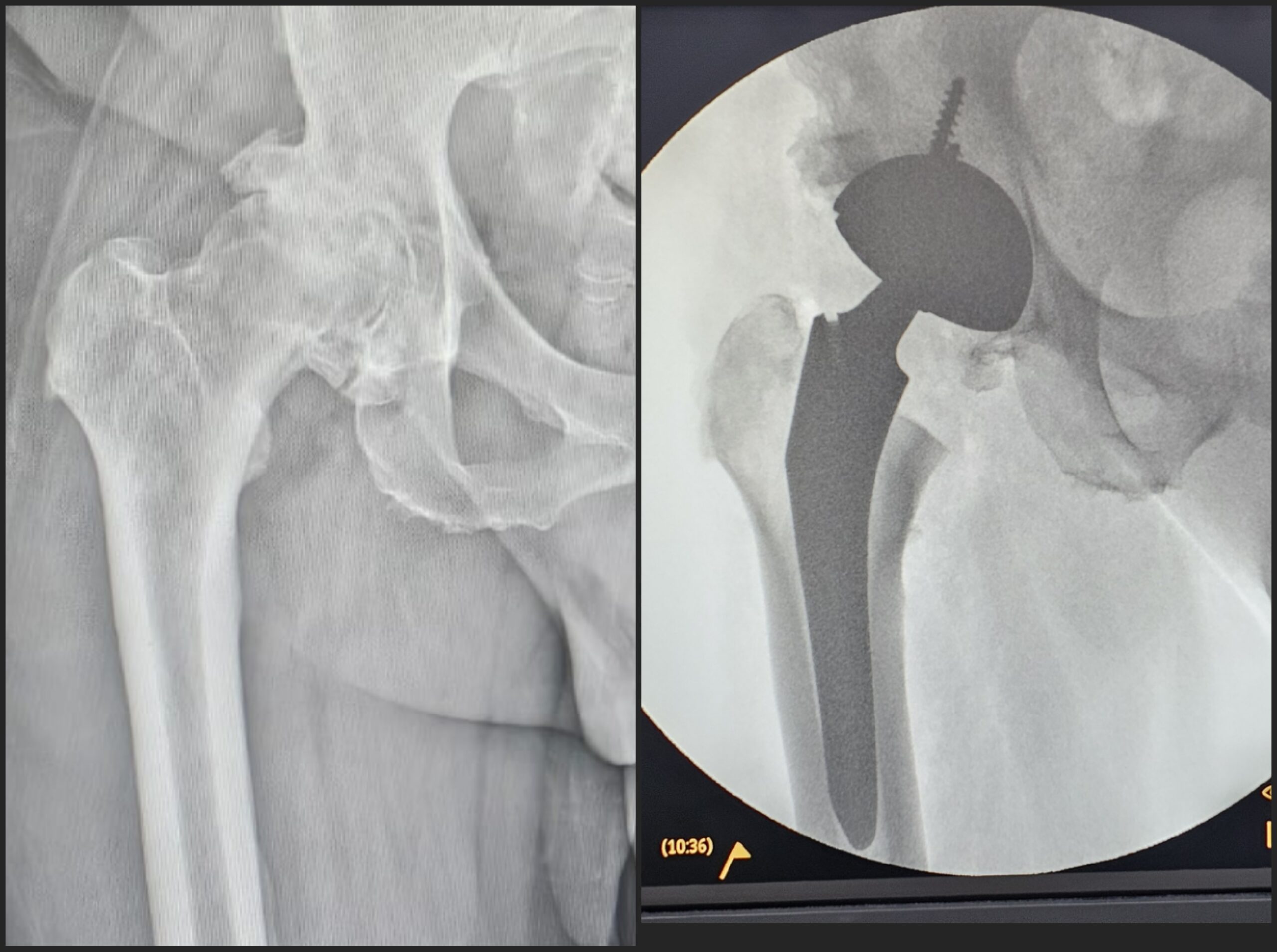 Artroplastia total do quadril por coxartrose ou fratura do colo do femur