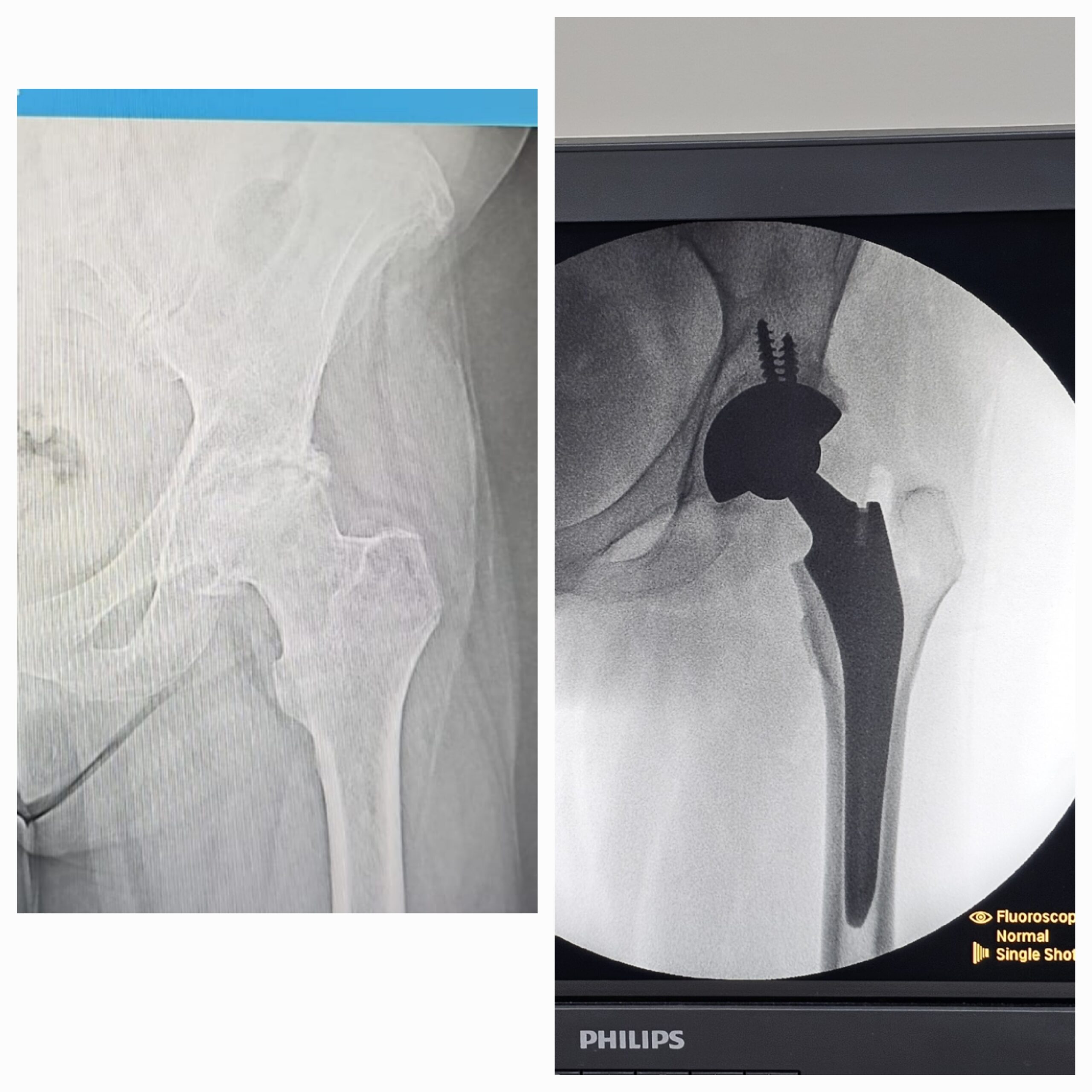 Artroplastia total do quadril por coxartrose ou fratura do colo do femur